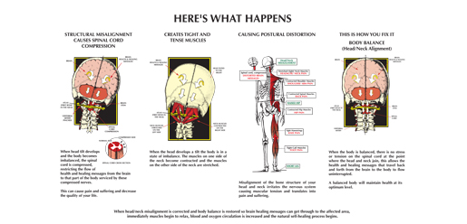 Chiropractic Canton MA Spinal Alignment Chart